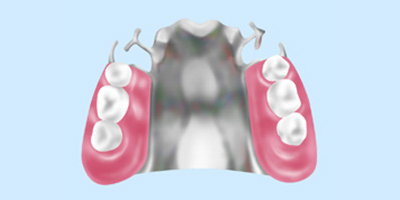 コバルトクロム床義歯