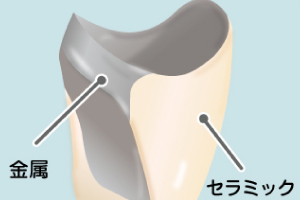 セラミック（メタル）